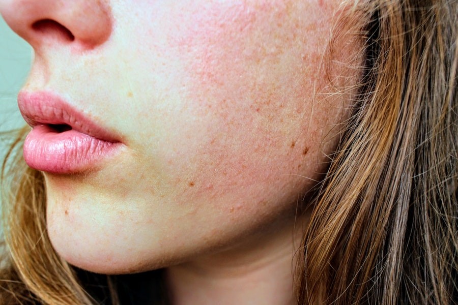 Houd je huid gezond met een laserbehandeling
